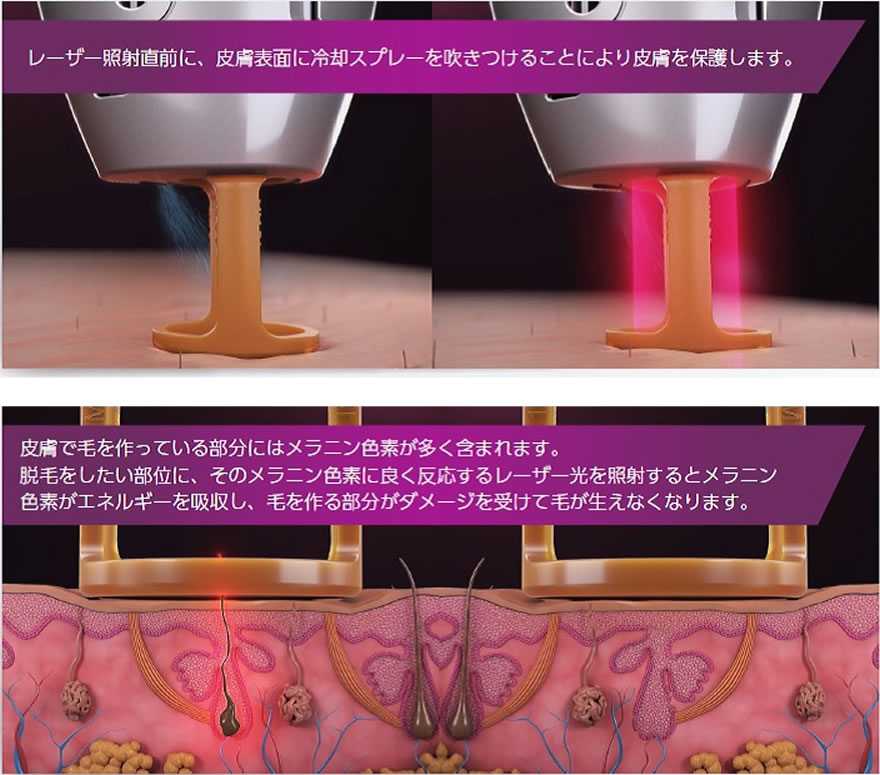 ムダ毛・医療脱毛 | 榎本整形外科 | 君津市久保