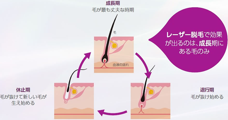 1回のレーザー脱毛ですべての毛を除去できないのはなぜ？